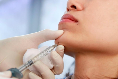 Tiêm filler cằm: Khoảng cách giữa chi phí và chất lượng
