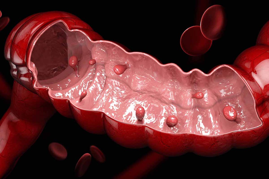 Polyp đại tràng nào dễ phát triển thành ung thư? - 1 Polyp đại tràng nào dễ phát triển thành ung thư? - 1