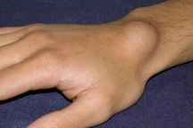 Nổi u, cục ở cổ tay: Có phải là dấu hiệu ung thư?