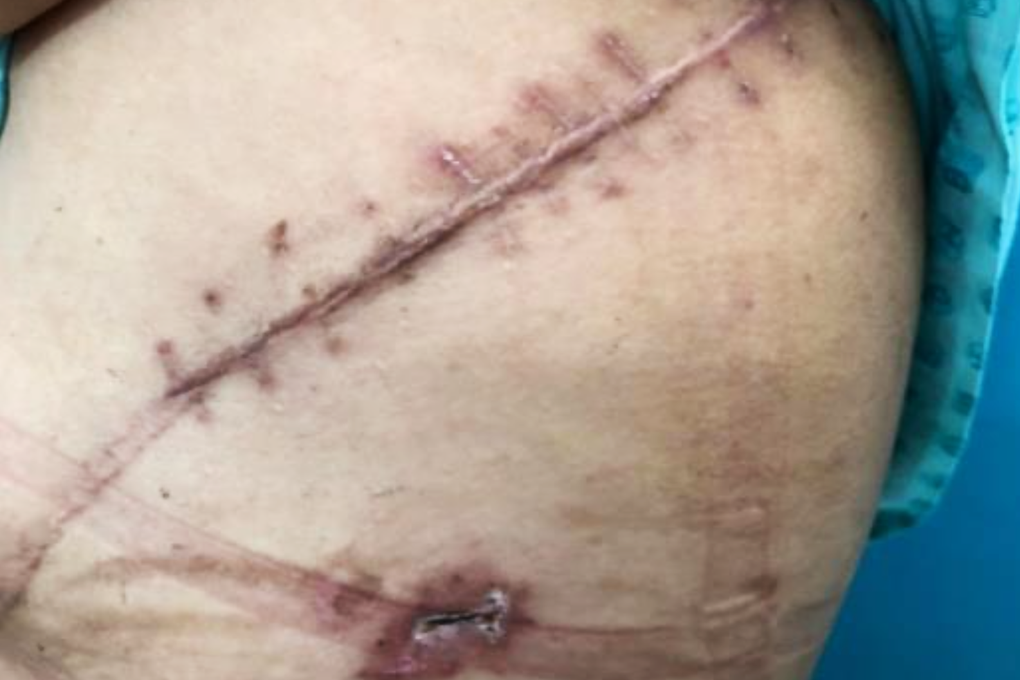 Một phụ nữ ở TPHCM nhức đầu, đau lưng suốt 2 năm vì khối u cực hiếm ở phổi - 2