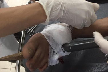 Kinh hoàng xà beng đâm thủng bàn chân thợ hồ