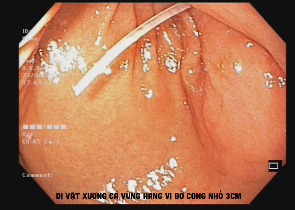 2 chiếc xương cá cùng đâm vào dạ dày - 2