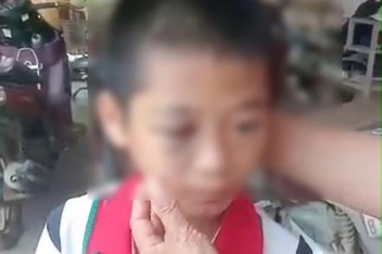 Làm rõ thông tin học sinh lớp 6 nghi bị mẹ kế bạo hành