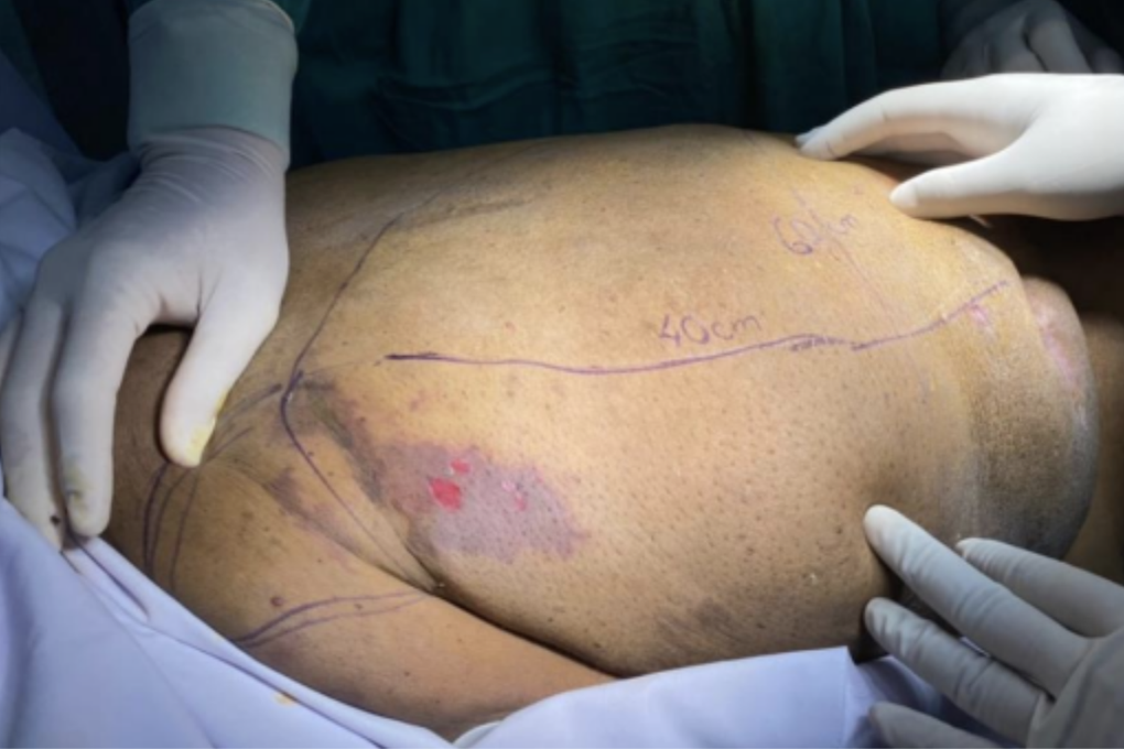 Người phụ nữ ở TPHCM mang mai rùa khổng lồ trên lưng vì căn bệnh hiếm - 2 Người phụ nữ ở TPHCM mang mai rùa khổng lồ trên lưng vì căn bệnh hiếm - 2