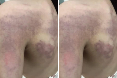 Đình chỉ công tác nữ giáo viên đánh học sinh lớp 3 bầm tím người