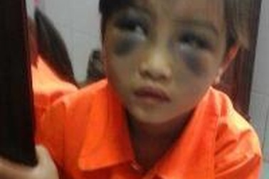 Phòng GD-ĐT Bát Xát: “Giáo viên đánh học sinh lớp 1 tím mặt, lo sợ và run lẩy bẩy”