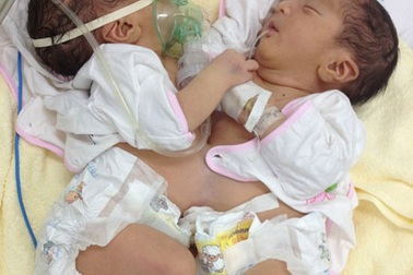  Tách thành công cặp song sinh dính liền 4 tháng tuổi
