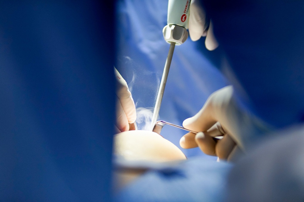 Ưu điểm của dao mổ siêu âm thế hệ mới Ultrasonic surgical scalpel - 3 Ưu điểm của dao mổ siêu âm thế hệ mới Ultrasonic surgical scalpel - 3