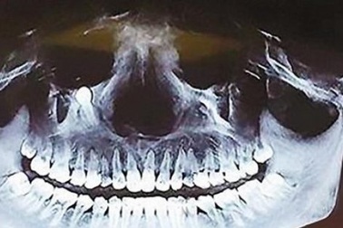 Ăn cơm thấy đau, đi khám thấy răng mọc gần mắt