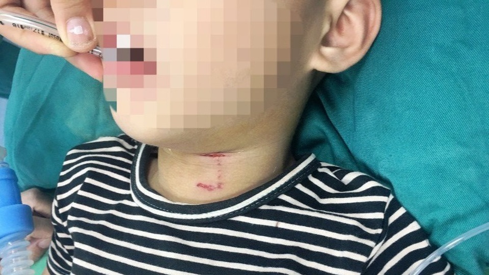 Bị chó hàng xóm tấn công, bé trai 3 tuổi rách vùng cổ, thủng khí quản - 1 Bị chó hàng xóm tấn công, bé trai 3 tuổi rách vùng cổ, thủng khí quản - 1