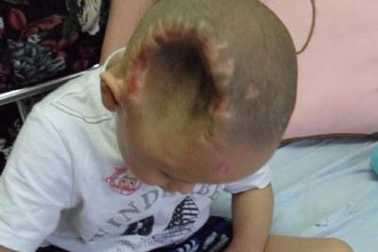 Bé trai 4 tuổi bị đánh lõm gần nửa đầu