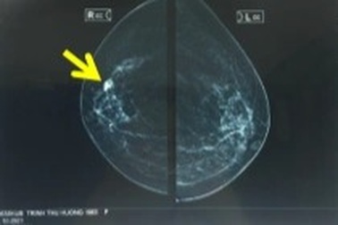 Nhiều trường hợp phát hiện ung thư vú khi tình cờ đi khám sàng lọc miễn phí