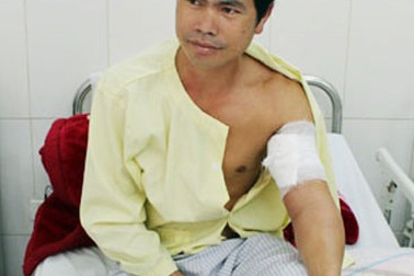 Phẫu thuật nối mạch máu ngoại vi cánh tay do khỉ cắn