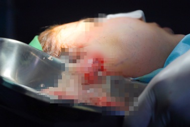 Tiêm tạo "má baby", trẻ hóa tái sinh, hot girl An Giang bị tai biến nặng nề