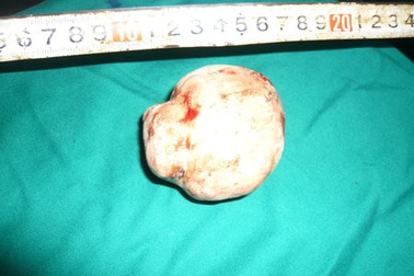 Lấy viên sỏi niệu đạo to bằng quả trứng vịt