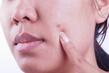 Mụn trứng cá - dấu hiệu cảnh báo ung thư?