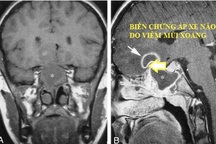 Viêm mũi xoang: Coi chừng biến chứng nguy hiểm khi thời tiết đổi mùa