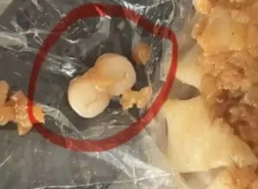 Liên tiếp các vụ phát hiện răng người trong đồ ăn gây xôn xao ở Trung Quốc - 2 Liên tiếp các vụ phát hiện răng người trong đồ ăn gây xôn xao ở Trung Quốc - 2