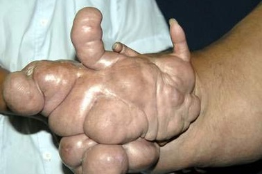 Phẫu thuật thành công u mỡ nặng 11kg