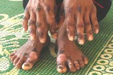 “Bệnh lạ” ở Quảng Ngãi không lạ như đồn đại