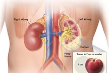 Phát hiện ung thư thận như thế nào?