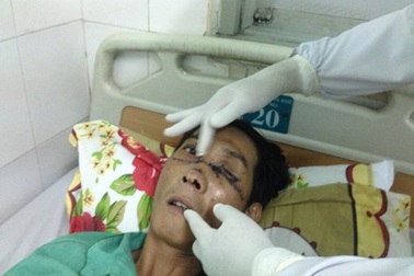 Gãy đôi xương mặt, múc bỏ nhãn cầu trái vì nổ bánh 'xe rùa'