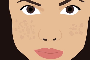 Cách nào trị sẹo mụn "cứng đầu"?