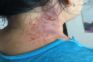 Nhiều bệnh nhân Covid-19 tại TPHCM bị kiến ba khoang "tấn công"