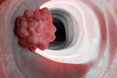 Tiên lượng của ung thư tá tràng