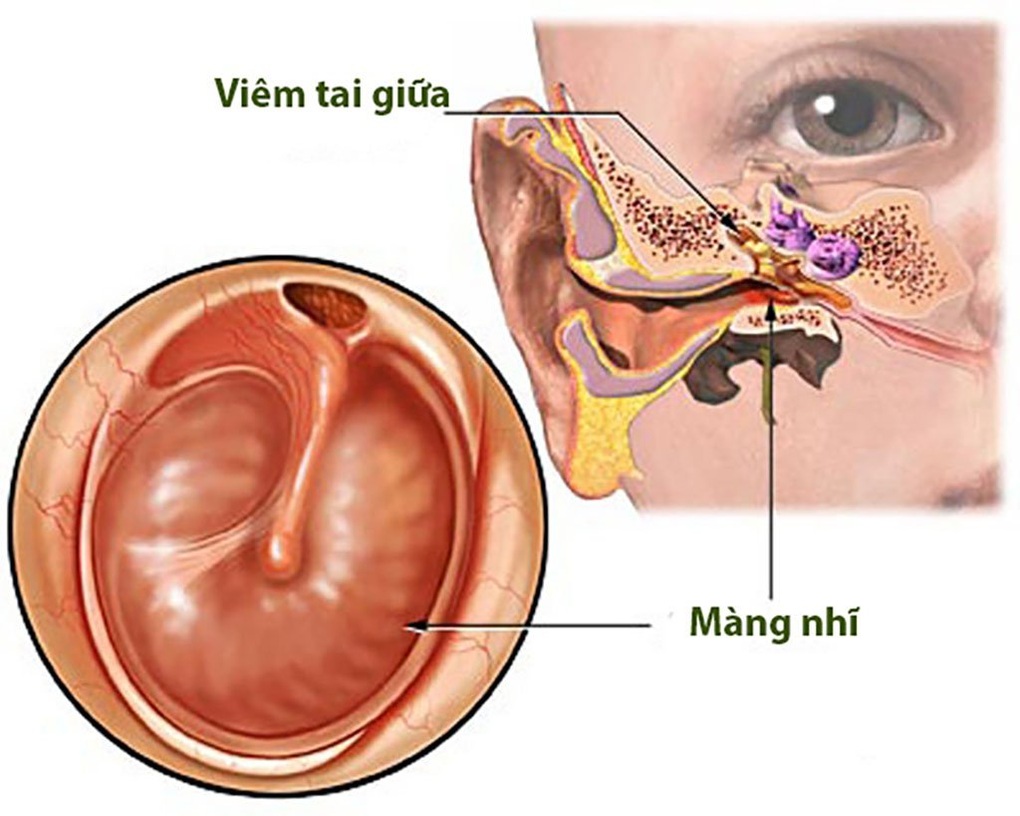 Hơn 2 giờ phẫu thuật cứu đôi tai bị thủng màng nhĩ do viêm tai giữa - 1 Hơn 2 giờ phẫu thuật cứu đôi tai bị thủng màng nhĩ do viêm tai giữa - 1