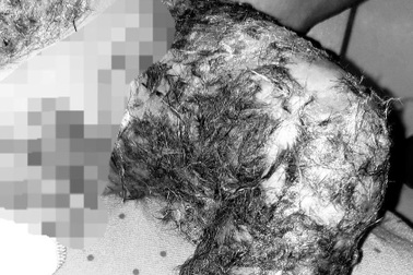 Rợn người với những cách chữa bỏng "truyền miệng"