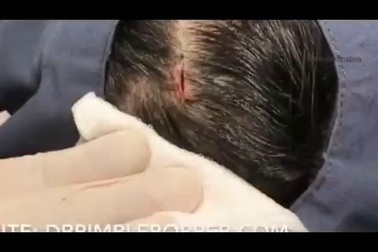 Mục sở thị quá trình lấy u nang thượng bì siêu nhanh