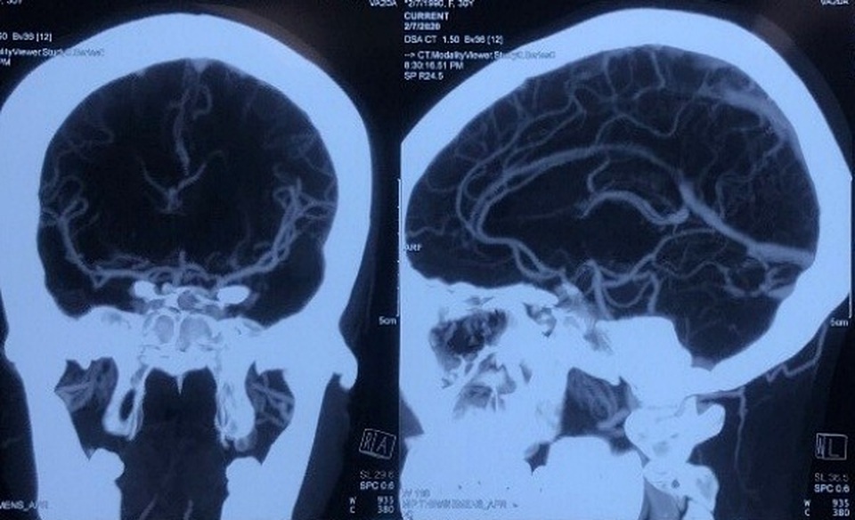 Nguyên nhân khiến cô gái 29 tuổi đã bị đột quỵ - 1 Nguyên nhân khiến cô gái 29 tuổi đã bị đột quỵ - 1