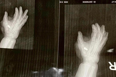 Nổ súng tại quán karaoke, một cháu bé bị thương