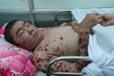 Hoại tử toàn thân vì bệnh lao da