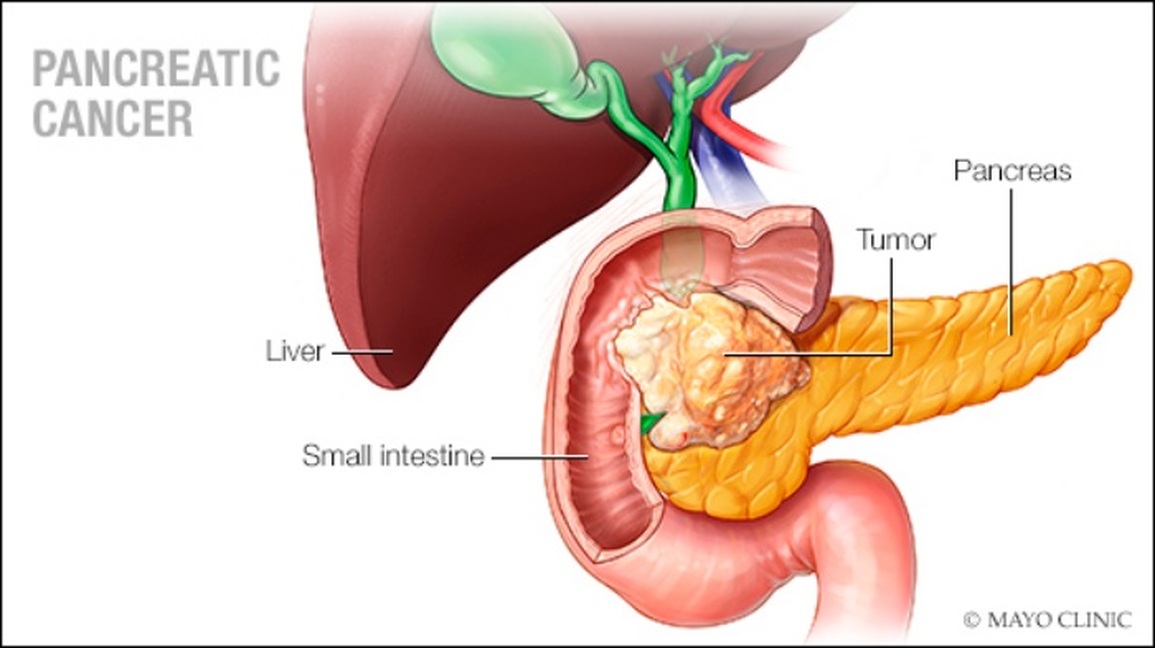 Mắc ung thư tuyến tụy sống được bao lâu? - 2 Mắc ung thư tuyến tụy sống được bao lâu? - 2