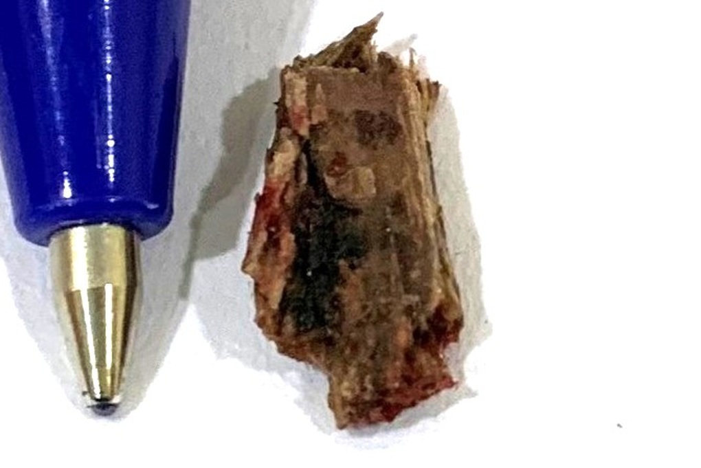 Ngã xe máy, người đàn ông 51 tuổi bị cây đâm sâu vào cổ - 2