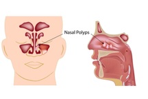 Polyp mũi: Triệu chứng và cách phòng ngừa