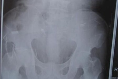 Phát hiện hơn 100 chiếc kim trong cơ thể bệnh nhân