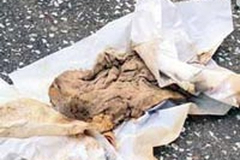 Sẽ xử lý nghiêm vụ quên gạc trong bụng bệnh nhân