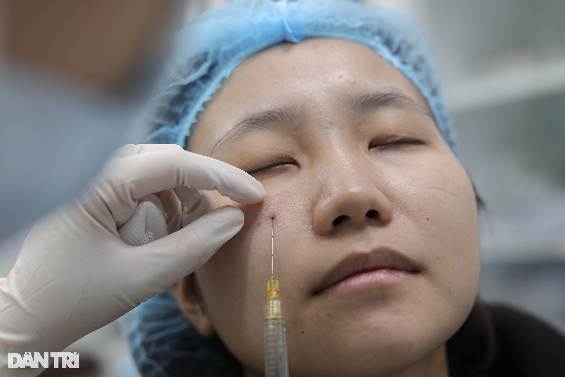 Gen Z chi gần 10 triệu để tiêm filler làm đầy hốc mắt - 6 Gen Z chi gần 10 triệu để tiêm filler làm đầy hốc mắt - 6