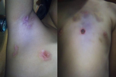 Bé gái 6 tuổi nghi bị cha dượng nghiện ma tuý châm tàn thuốc khắp người