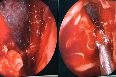 “Bỏ quên” chiếc đũa suốt 4 năm trong hốc mắt