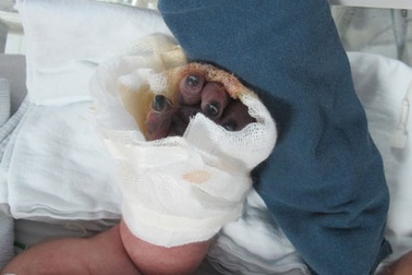 Bé sơ sinh hoại tử 5 đầu ngón tay đã tử vong