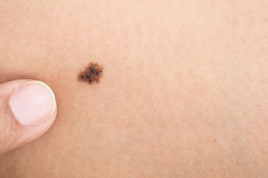 Ánh nắng mặt trời là tác nhân chủ yếu gây bệnh ung thư này