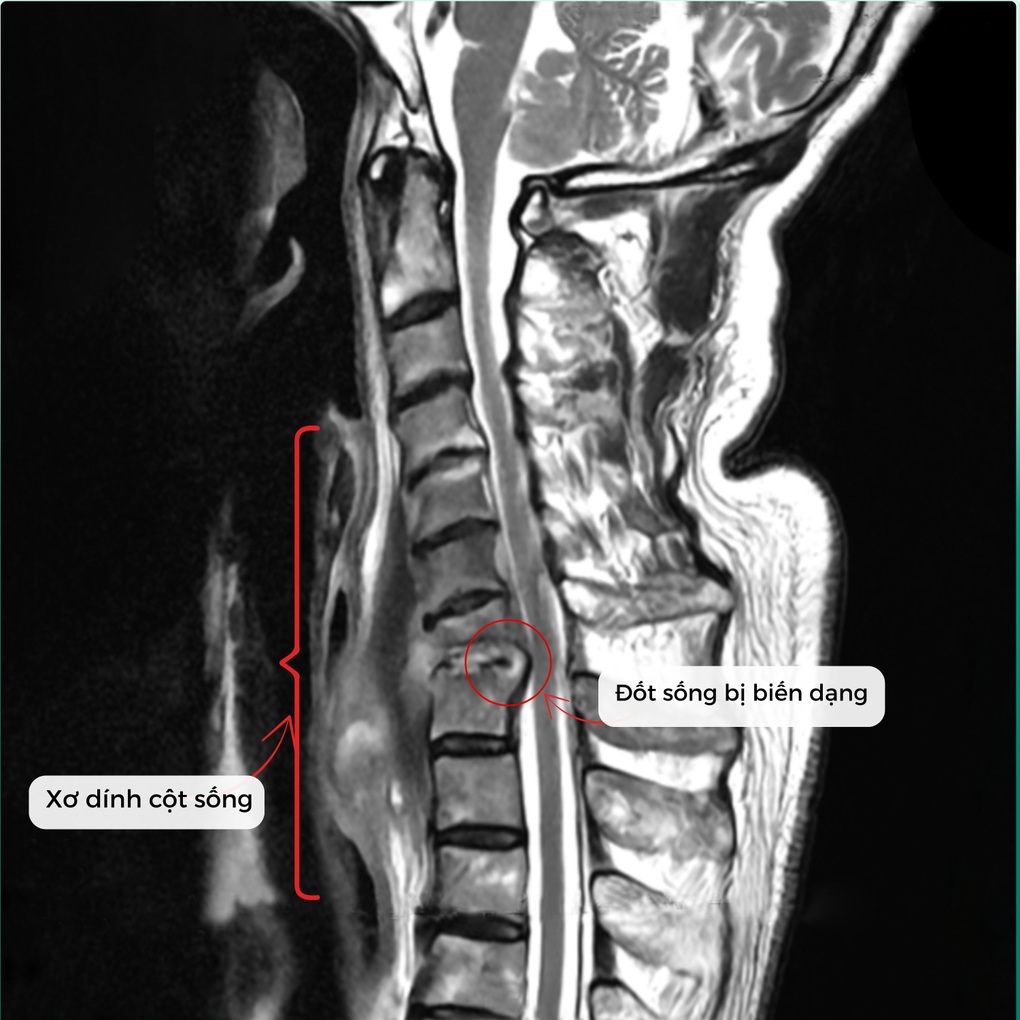Giáo sư người Nhật mắc bệnh hiếm, sang Việt Nam điều trị thành công - 2 Giáo sư người Nhật mắc bệnh hiếm, sang Việt Nam điều trị thành công - 2