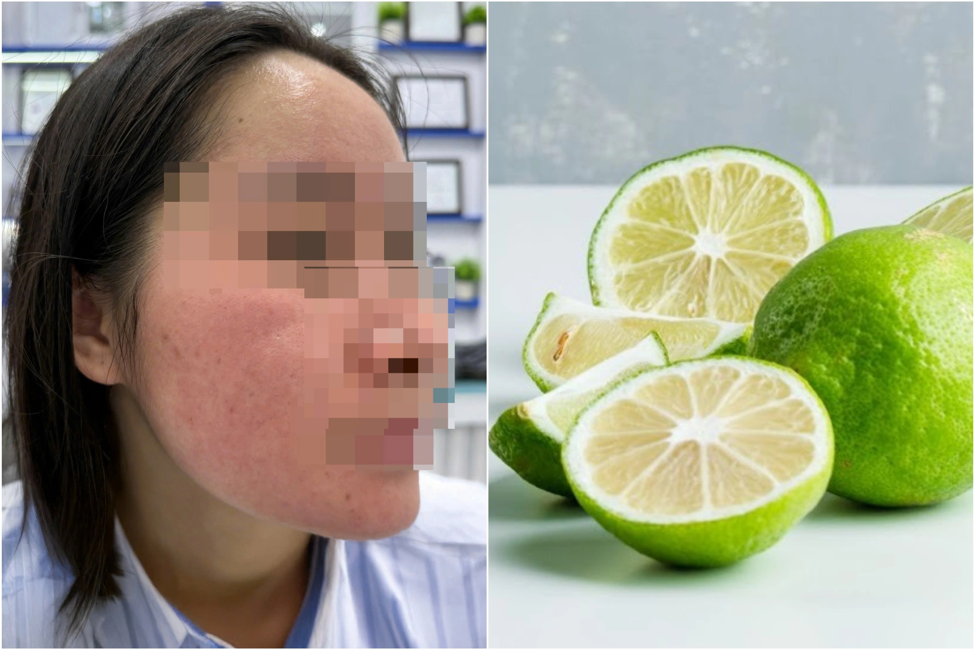 Bôi chanh lên mặt trị mụn theo hội nhóm Facebook, thiếu nữ mặt nở hoa - 1