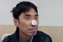 Cho chó nhà ăn, người đàn ông bị cắn bong mảng da lớn ở mũi