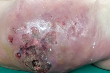 Choáng vì vùng mông hoại tử nặng, bốc mùi thối sau tiêm silicon lỏng nâng cấp vòng 3