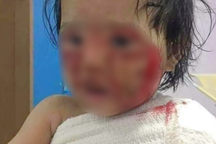 Đau lòng nhiều trẻ bỏng nặng ngay tại nhà vì cồn, xăng bốc cháy trong bếp